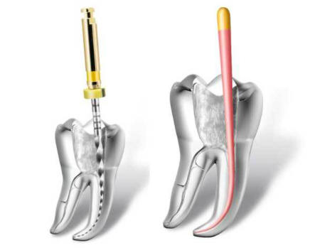 Le traitement endodontique